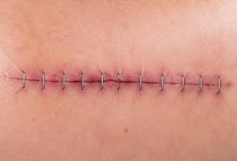 Klammern (Staples)